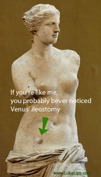 Venus de Milo's ileostomy
