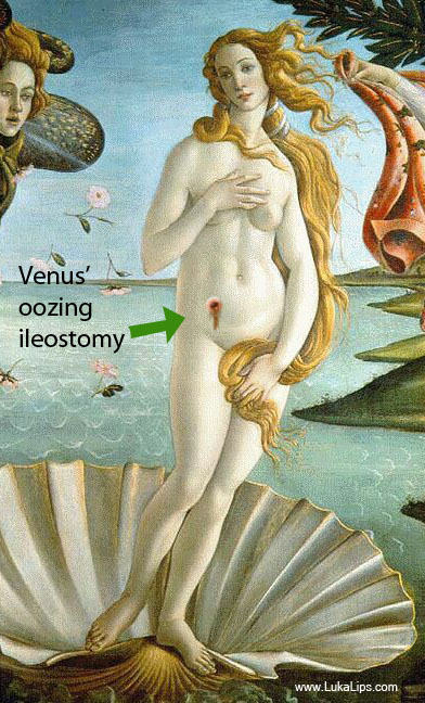 Botticelli Venus with oozing bile from ileostomy